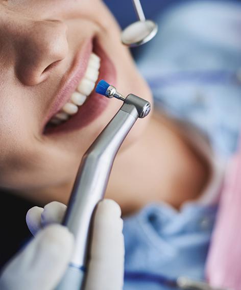 Closeup of a woman’s teeth about to be polished with special brush