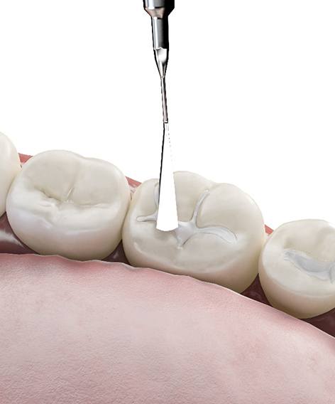 Rendering of dental instrument applying composite resin to cavities in lower arch