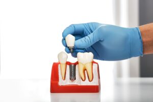 Gloved hand placing model dental crown over sample implant
