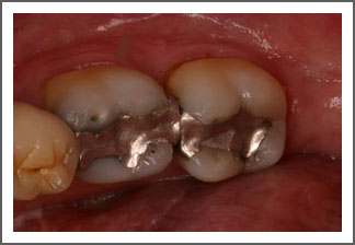 Teeth before crown treatment