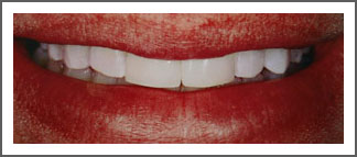 Mouth/teeth after dental implant treatment