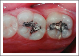 Teeth before tooth colored restoration treatment