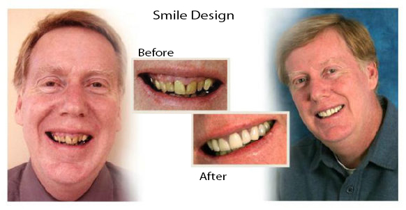Patient's teeth/mouth and face before and after treatment