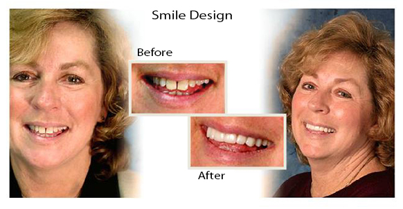 Patient's teeth/mouth and face before and after treatment